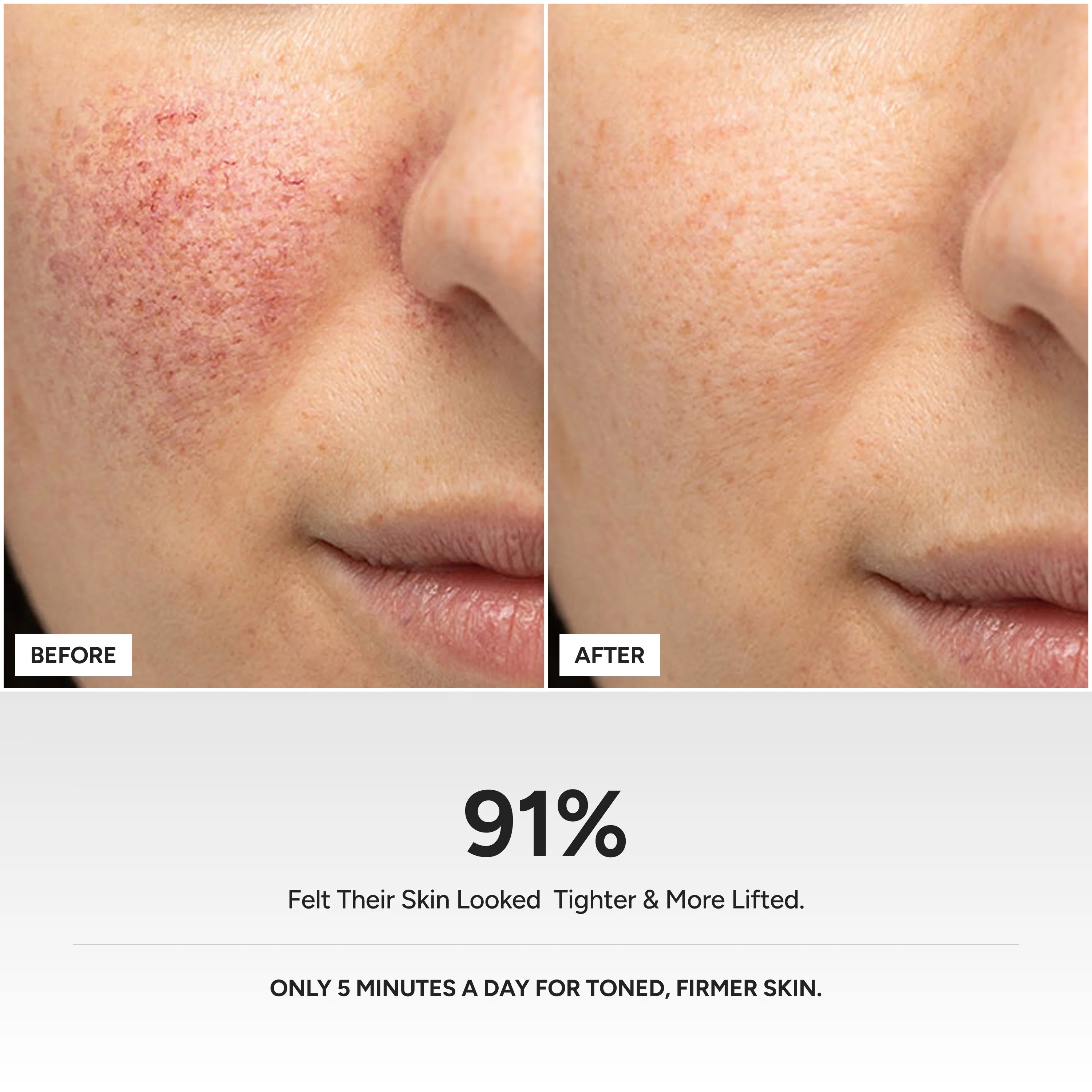 Micro Skin Lift Device